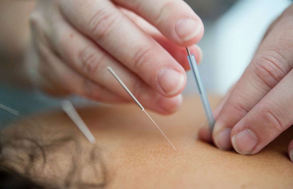 Close-up of hands applying acupuncture needles with precision and care during the procedure.